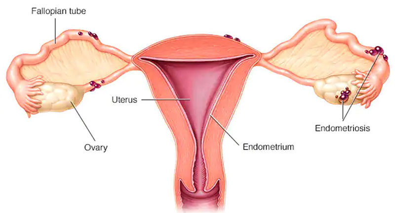 Best Endometriosis Treatment Doctors in Andheri